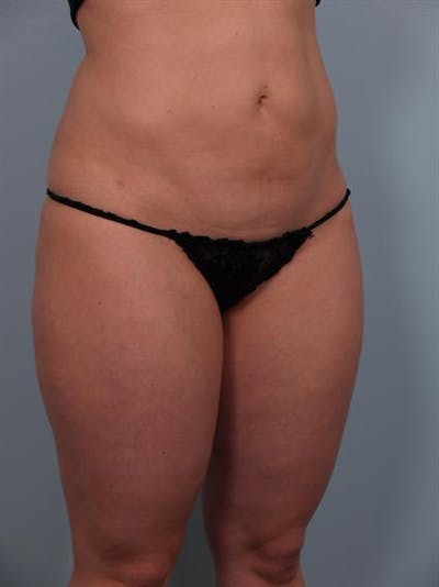 Power Assisted Liposuction Before & After Gallery - Patient 1310756 - Image 6