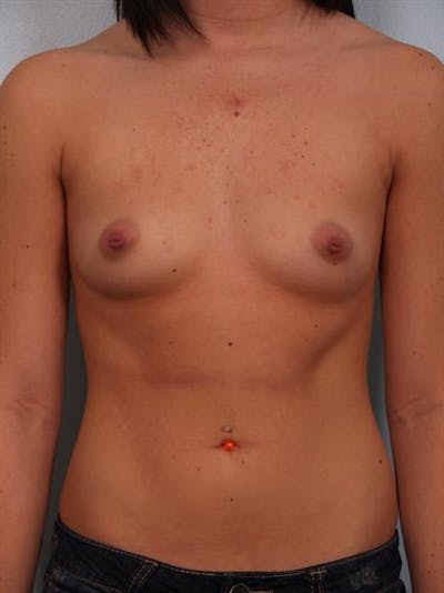 Breast Augmentation Before & After Gallery - Patient 1310762 - Image 1
