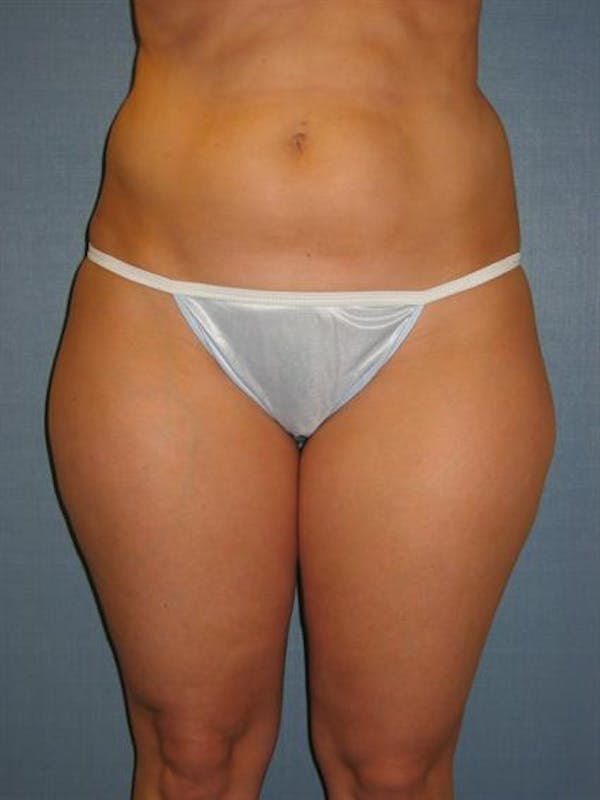 Power Assisted Liposuction Before & After Gallery - Patient 1310756 - Image 7