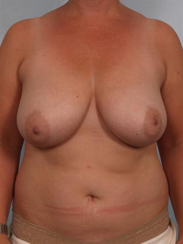 Breast Reduction Gallery - Patient 1310761 - Image 1