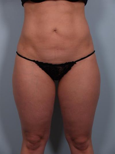 Power Assisted Liposuction Before & After Gallery - Patient 1310756 - Image 8