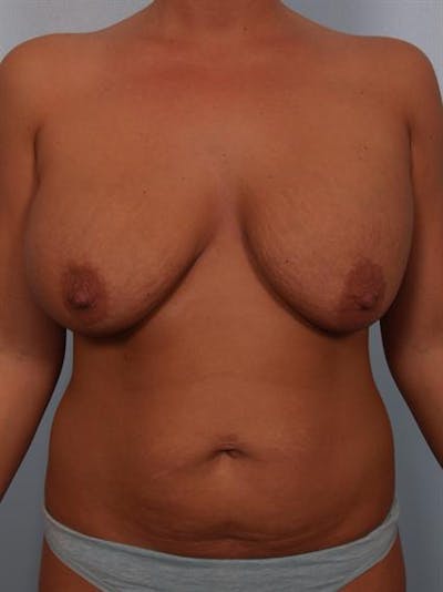 Complex Breast Revision Before & After Gallery - Patient 1310764 - Image 1