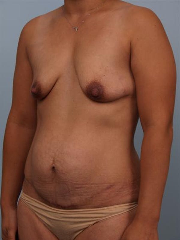 Breast Lift Before & After Gallery - Patient 1310759 - Image 5