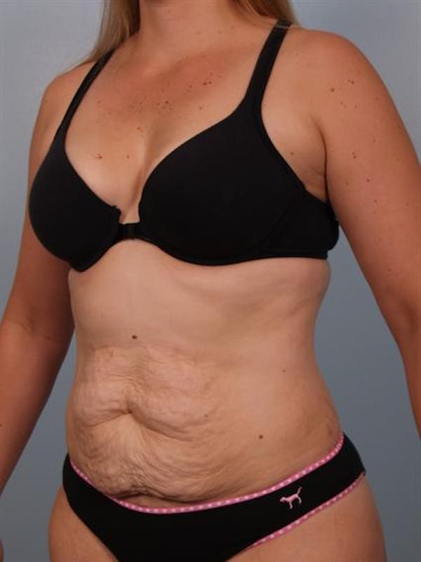 Tummy Tuck Before & After Gallery - Patient 1310767 - Image 1