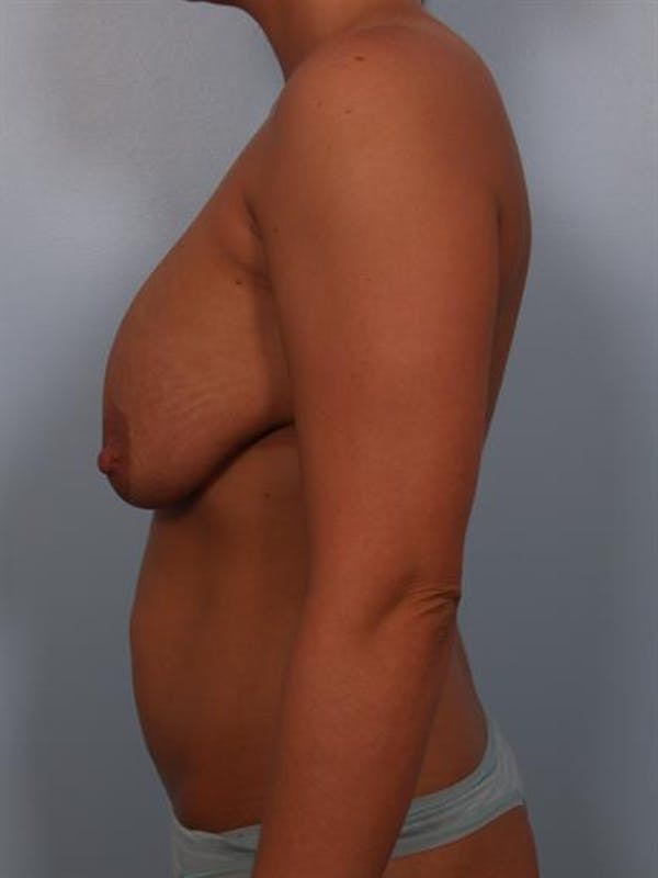 Complex Breast Revision Before & After Gallery - Patient 1310764 - Image 3