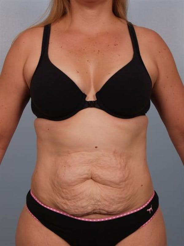 Tummy Tuck Before & After Gallery - Patient 1310767 - Image 3