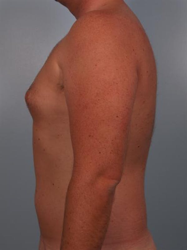 Power Assisted Liposuction Before & After Gallery - Patient 1310769 - Image 3