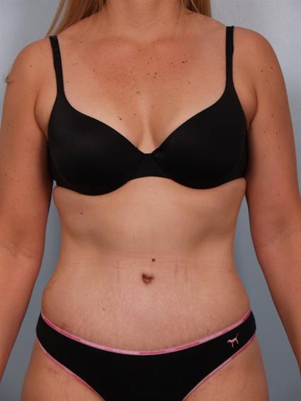 Tummy Tuck Before & After Gallery - Patient 1310767 - Image 4