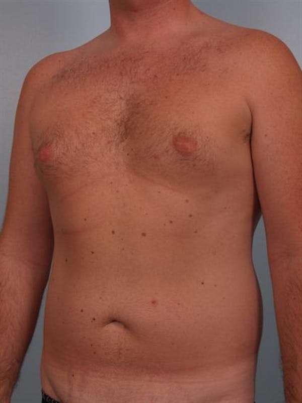 Power Assisted Liposuction Before & After Gallery - Patient 1310769 - Image 5