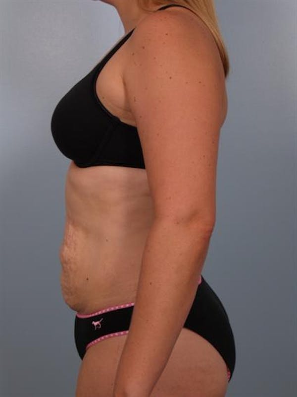 Tummy Tuck Before & After Gallery - Patient 1310767 - Image 5