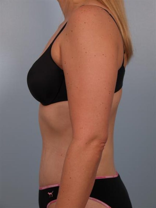 Tummy Tuck Before & After Gallery - Patient 1310767 - Image 6