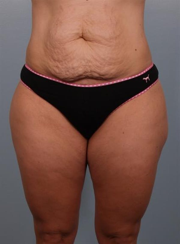 Tummy Tuck Before & After Gallery - Patient 1310767 - Image 7