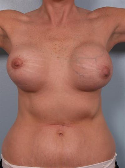 Complex Breast Revision Before & After Gallery - Patient 1310774 - Image 1