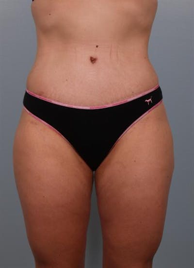 Tummy Tuck Before & After Gallery - Patient 1310767 - Image 8