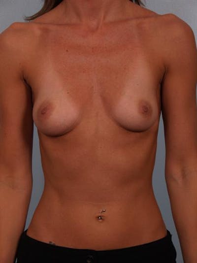 Breast Augmentation Before & After Gallery - Patient 1310775 - Image 1