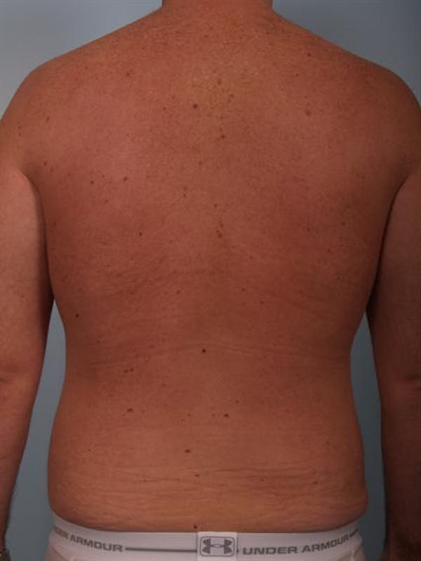 Power Assisted Liposuction Before & After Gallery - Patient 1310769 - Image 8