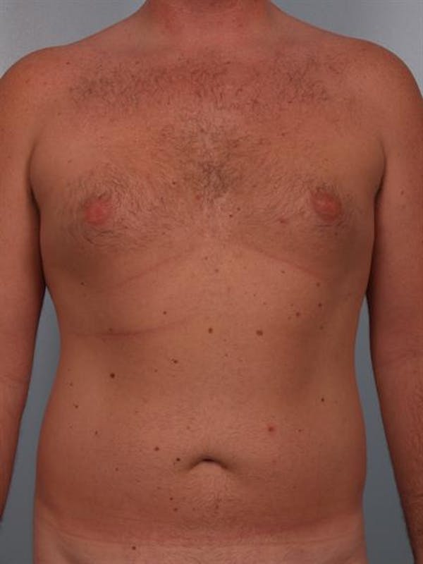 Power Assisted Liposuction Before & After Gallery - Patient 1310769 - Image 9