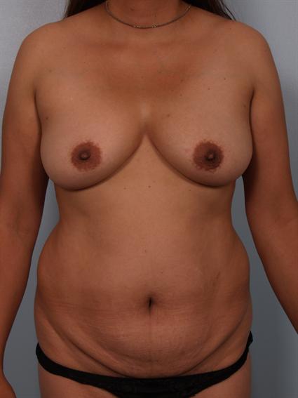 Image4 - Before image of Liposuction in Beverly Hills by Dr. Cohen.