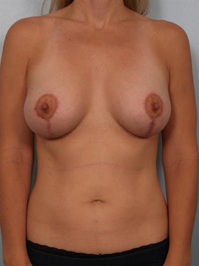 Breast Lift Before & After Gallery - Patient 1310773 - Image 2