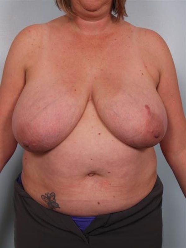 Breast Reduction Before & After Gallery - Patient 1310776 - Image 1