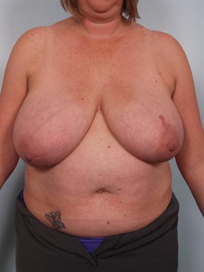 Breast Reduction Before & After Gallery - Patient 1310776 - Image 1