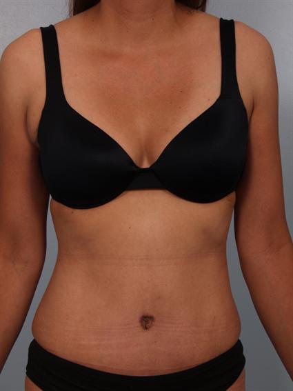 Image4 - After image of Liposuction in Beverly Hills by Dr. Cohen.