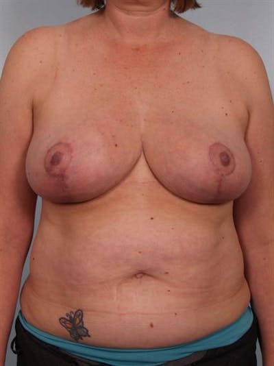 Breast Reduction Before & After Gallery - Patient 1310776 - Image 2