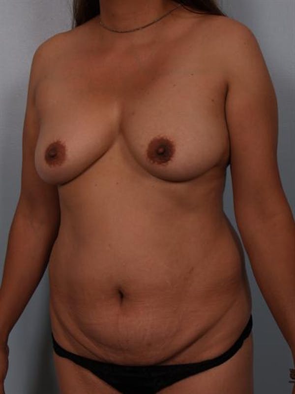 Power Assisted Liposuction Before & After Gallery - Patient 1310778 - Image 3