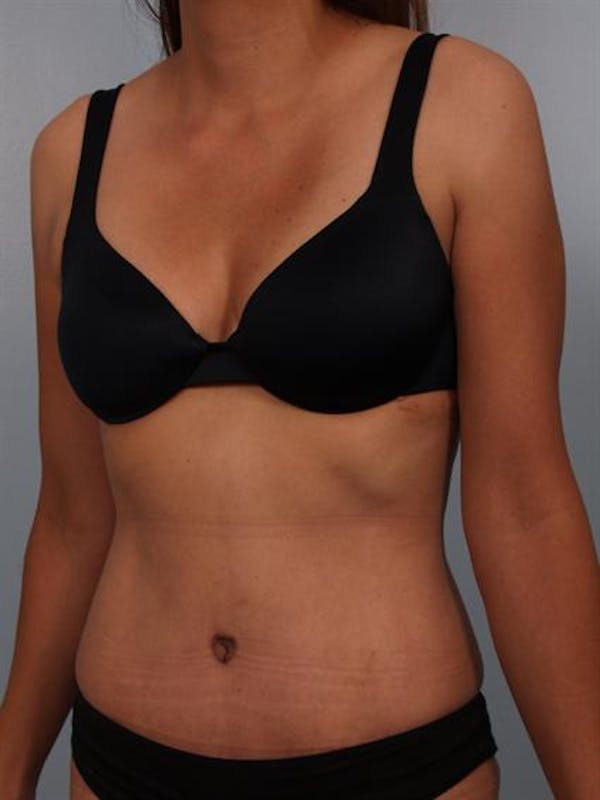 Power Assisted Liposuction Before & After Gallery - Patient 1310778 - Image 4
