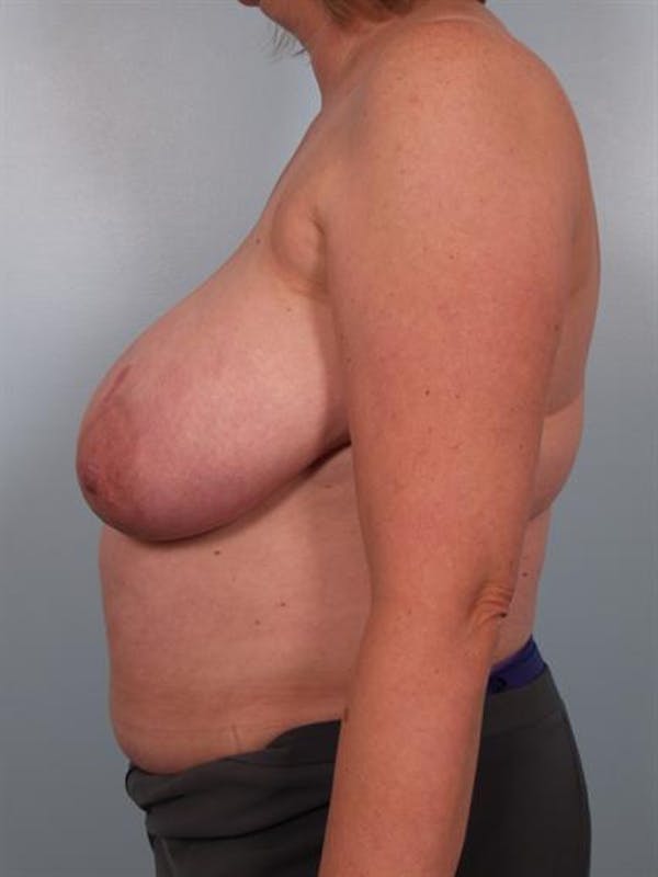 Breast Reduction Before & After Gallery - Patient 1310776 - Image 3