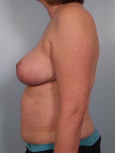 Breast Reduction Before & After Gallery - Patient 1310776 - Image 4