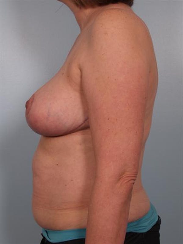 Breast Reduction Gallery - Patient 1310776 - Image 4