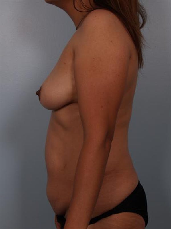 Power Assisted Liposuction Gallery - Patient 1310778 - Image 5