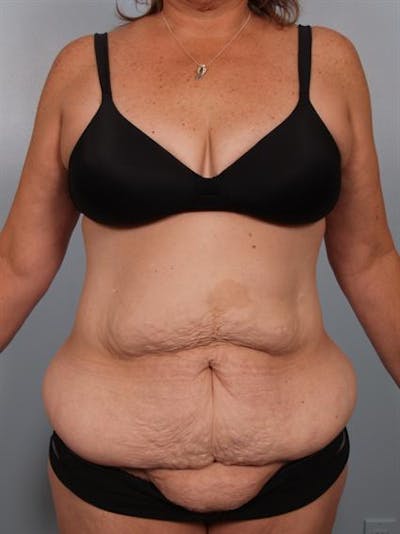Tummy Tuck Before & After Gallery - Patient 1310780 - Image 1