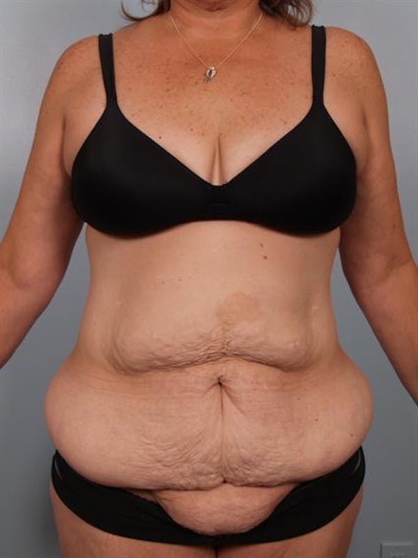 Tummy Tuck Gallery - Patient 1310780 - Image 1