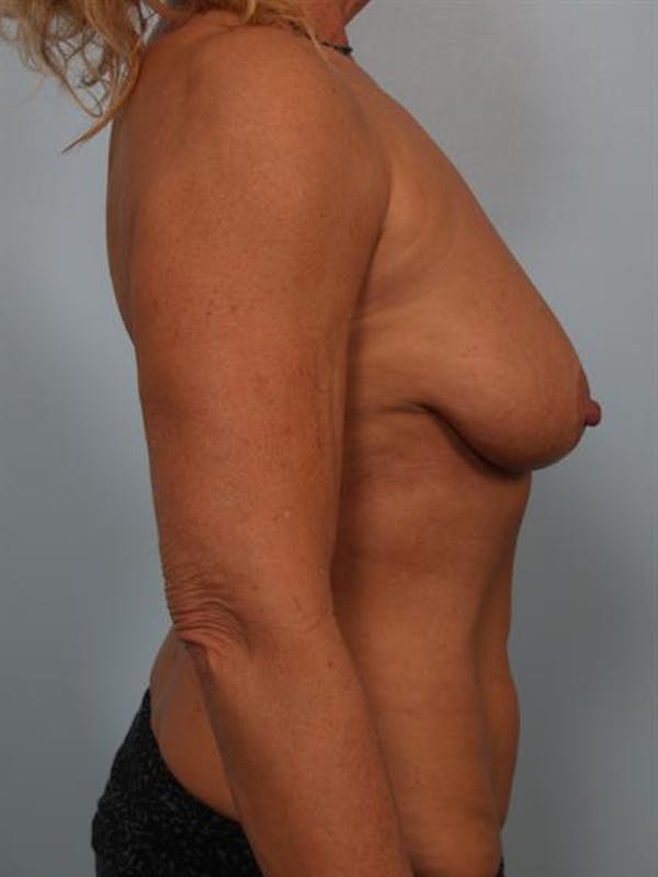 Breast Lift Gallery - Patient 1310779 - Image 3