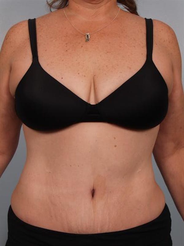 Tummy Tuck Before & After Gallery - Patient 1310780 - Image 2