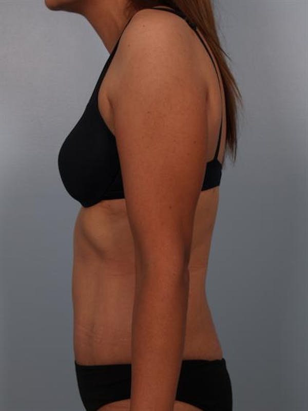 Power Assisted Liposuction Before & After Gallery - Patient 1310778 - Image 6