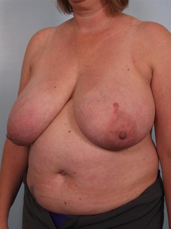 Breast Reduction Before & After Gallery - Patient 1310776 - Image 5