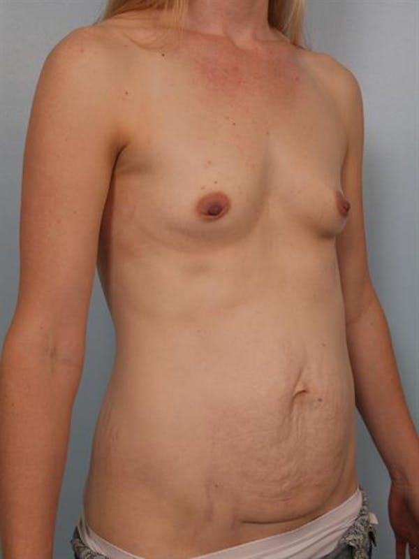 Mommy Makeover Before & After Gallery - Patient 1310777 - Image 5