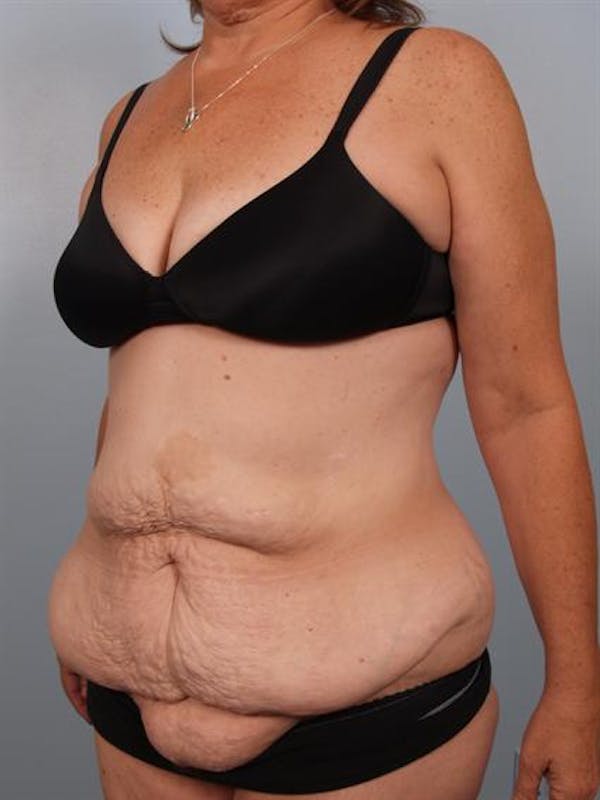 Tummy Tuck Before & After Gallery - Patient 1310780 - Image 3