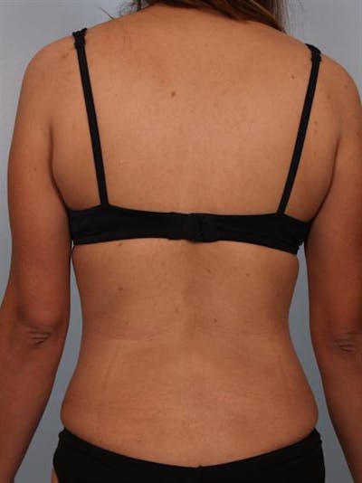 Power Assisted Liposuction Gallery - Patient 1310778 - Image 8