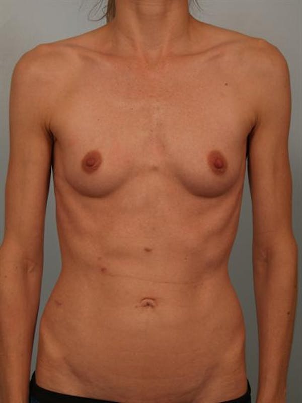 Breast Augmentation Gallery - Patient 1310786 - Image 1