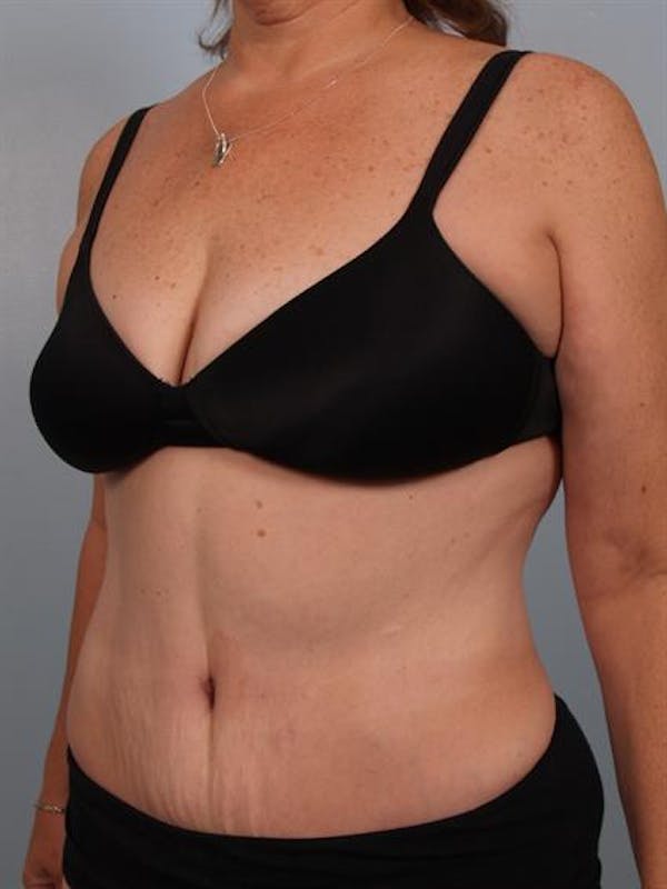 Tummy Tuck Before & After Gallery - Patient 1310780 - Image 4