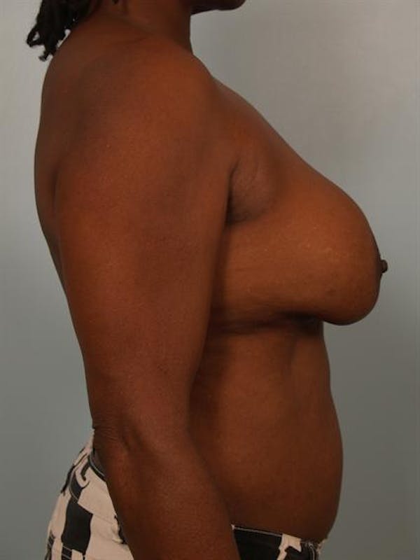 Complex Breast Revision Before & After Gallery - Patient 1310781 - Image 5