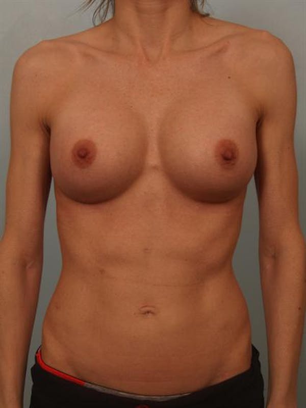 Breast Augmentation Gallery - Patient 1310786 - Image 2