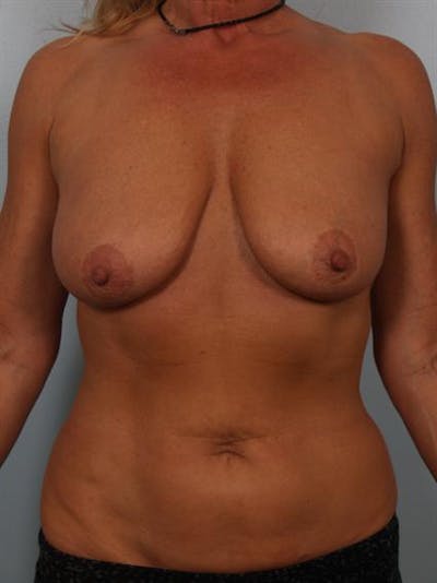 Breast Lift Before & After Gallery - Patient 1310779 - Image 1