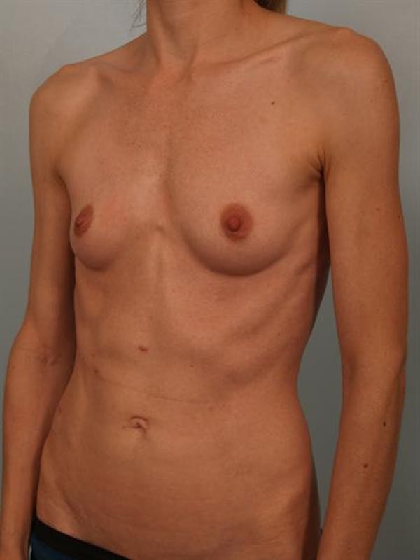 Breast Augmentation Before & After Gallery - Patient 1310786 - Image 3