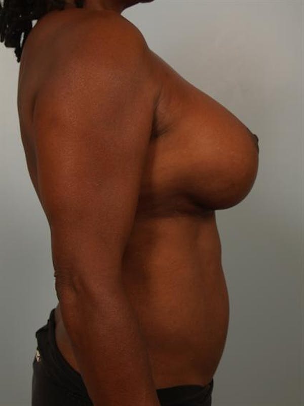 Complex Breast Revision Before & After Gallery - Patient 1310781 - Image 6