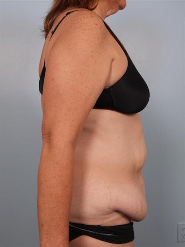 Tummy Tuck Before & After Gallery - Patient 1310780 - Image 5